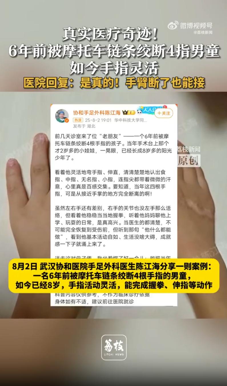 6年前被絞斷4指男童如今手指靈活
